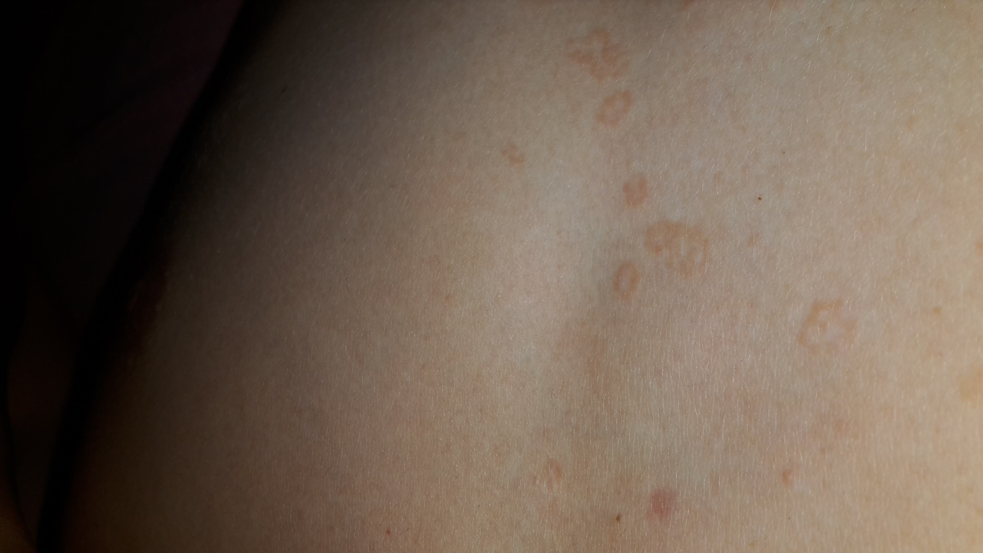 Habe seit einiger Zeit so braune Flecken zwischen der Brust. Kein Habe seit einiger Zeit so braune Flecken zwischen der Brust. Kein