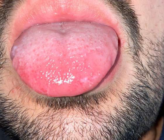 Habe Seit Gestern Zahneputzen Rote Flecken Auf Der Zunge Und Brennen Gesundheit Und Medizin Innere Medizin Habe Seit Gestern Zahneputzen Rote Flecken Auf Der Zunge Und Brennen Gesundheit Und Medizin Innere Medizin