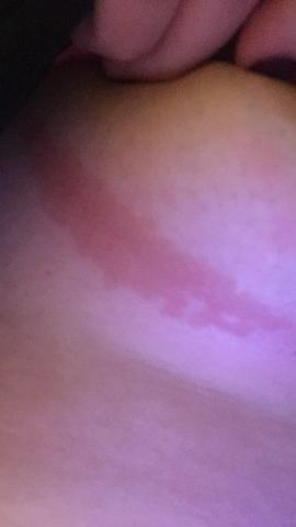 Habe Seit Paar Monaten So Ein Fleck Unter Der Brust Habe Ein Termin Beim Hautarzt Bekommen Aber Erst Im Dezember Sollte Ich Mein Termin Lieber Vorschieben Flecken Habe Seit Paar Monaten So Ein Fleck Unter Der Brust Habe Ein Termin Beim Hautarzt Bekommen Aber Erst Im Dezember Sollte Ich Mein Termin Lieber Vorschieben Flecken