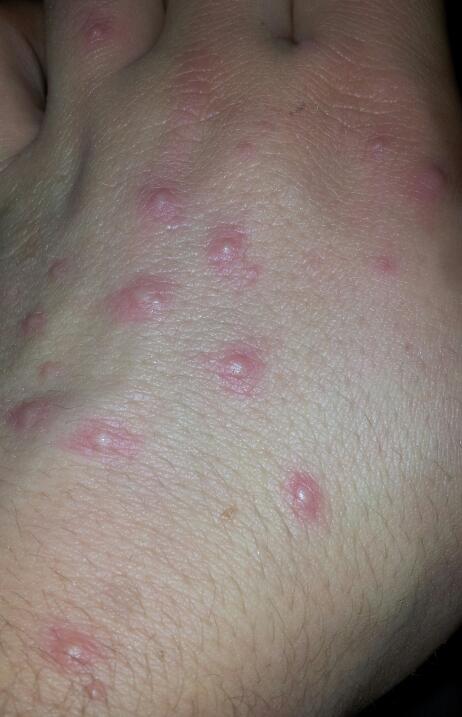 Habe seit paar Tagen an den Händen bläschen, was kann es sein