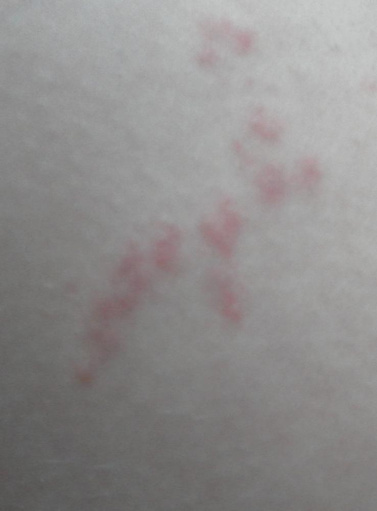 pickel auf dem oberschenkel pickel auf dem oberschenkel