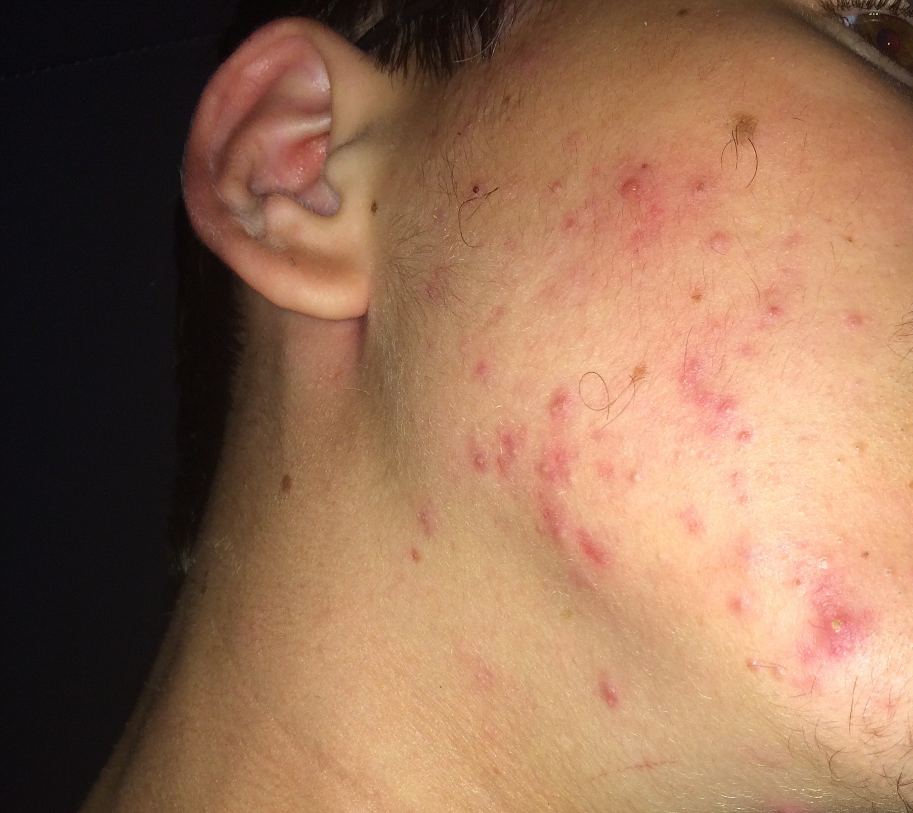 Habe viele Pickel auf meiner Backe was kann man machen? (Gesicht) pickel hintern