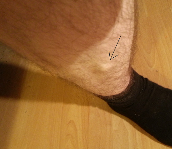 Habt Ihr Auch So Einen Knubbel An Den Schienbeinen Belastung Schienbein Habt Ihr Auch So Einen Knubbel An Den Schienbeinen Belastung Schienbein