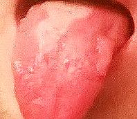 Weiße Flecken Auf Der Zunge