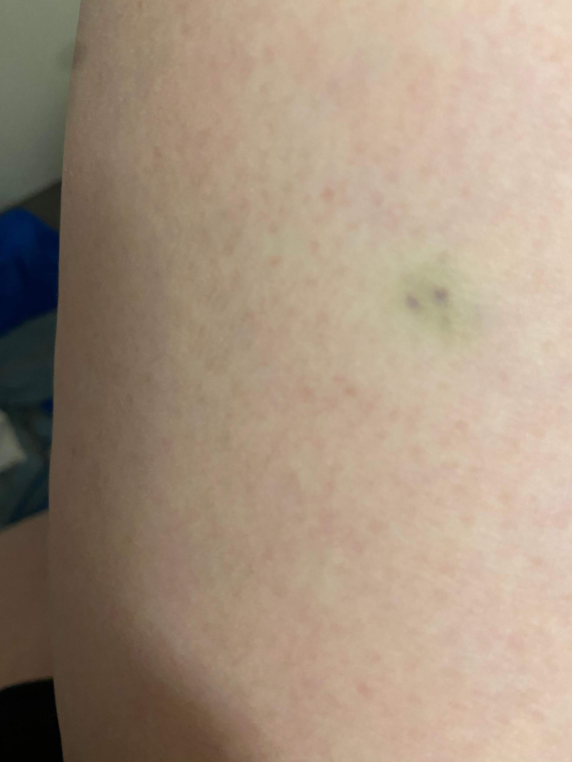 Hämatome? (Gesundheit und Medizin, Hämatom)