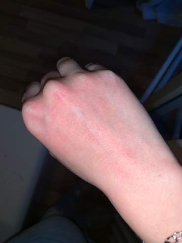 Hande Brennen Und Sind Rot Gesundheit Und Medizin Haut Hand