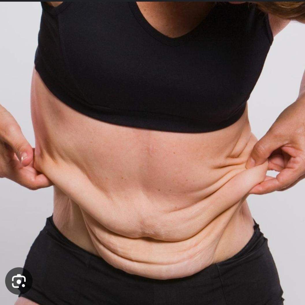 Hängt Die Haut Wenn Man 20 Kg Abnimmt