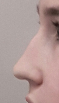 Hassliche Hockernase Wie Schlimm Schonheit Nase Selbstbewusstsein