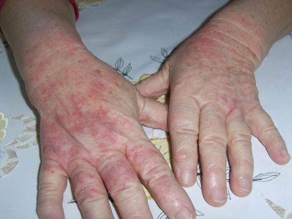 Hände mit Ausschlag II - (Gesundheit, Allergie)