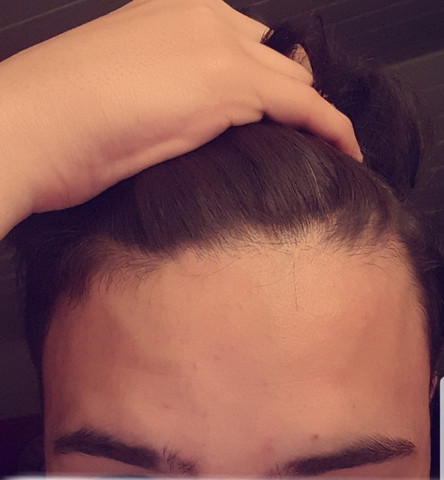 Hairline Versaut Friseur Was Soll Ich Tun Haare Haarschnitt Fail