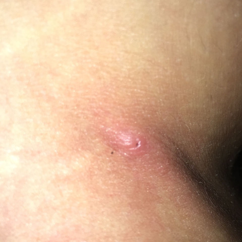 Halbe Zecke Noch Im Bein Gesundheit Tiere Arzt Halbe Zecke Noch Im Bein Gesundheit Tiere Arzt