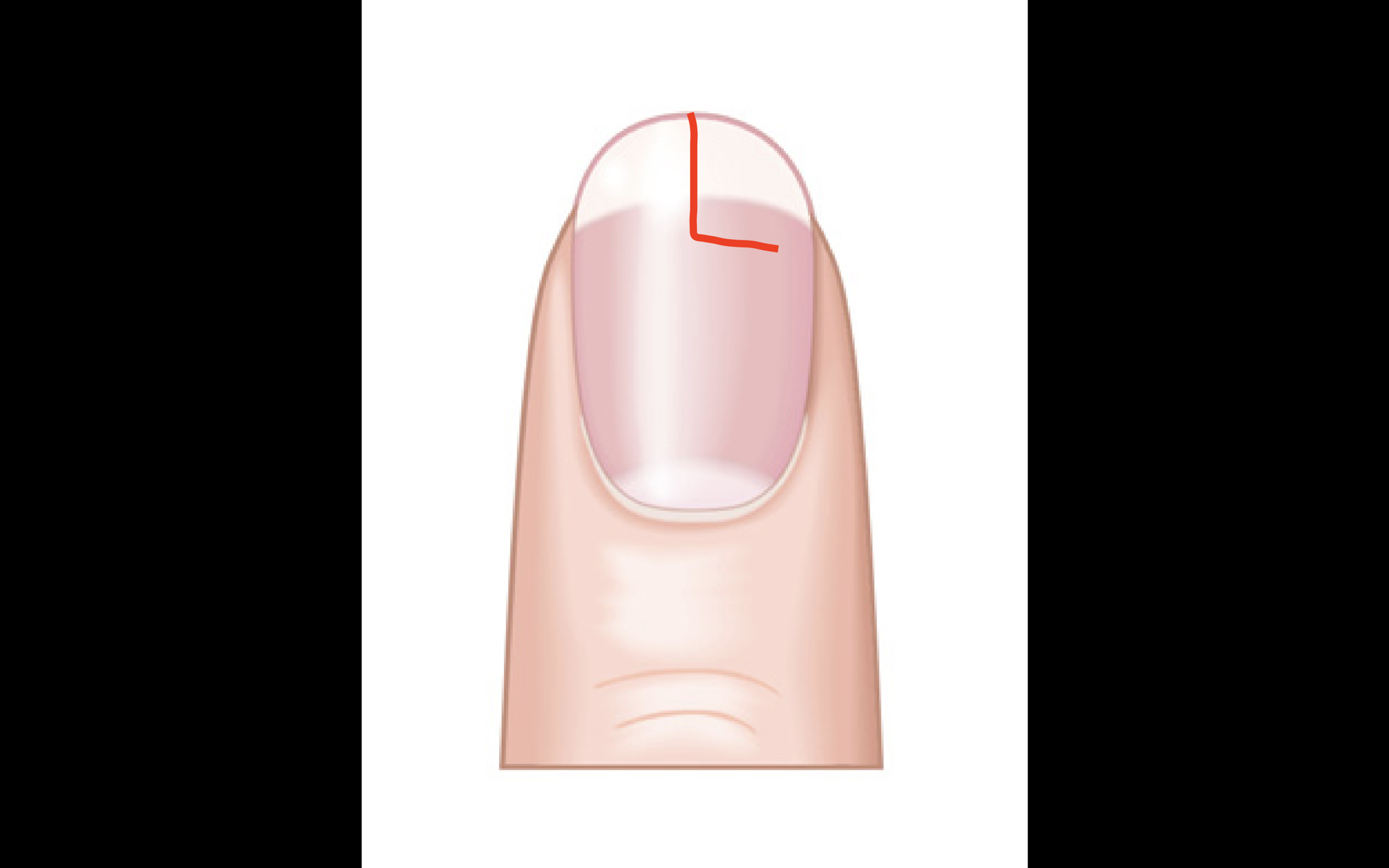 Grüner Nagel Unter Kunstnagel Was Tun halber nagel eingerissen was tun? (Haut, Nägel, Hand)