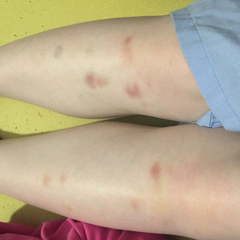 Hallo Community Ich Wache Morgens Schon Langer Mit Blauen Flecken Am Schienbein Auf Was Kann Das Alles Sein Gesundheit Gefahrlich Hallo Community Ich Wache Morgens Schon Langer Mit Blauen Flecken Am Schienbein Auf Was Kann Das Alles Sein Gesundheit Gefahrlich