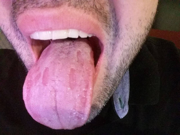 Symptome_Weiße Zunge - (HIV, Lymphknotenschwellung, HIV Selbsttest)