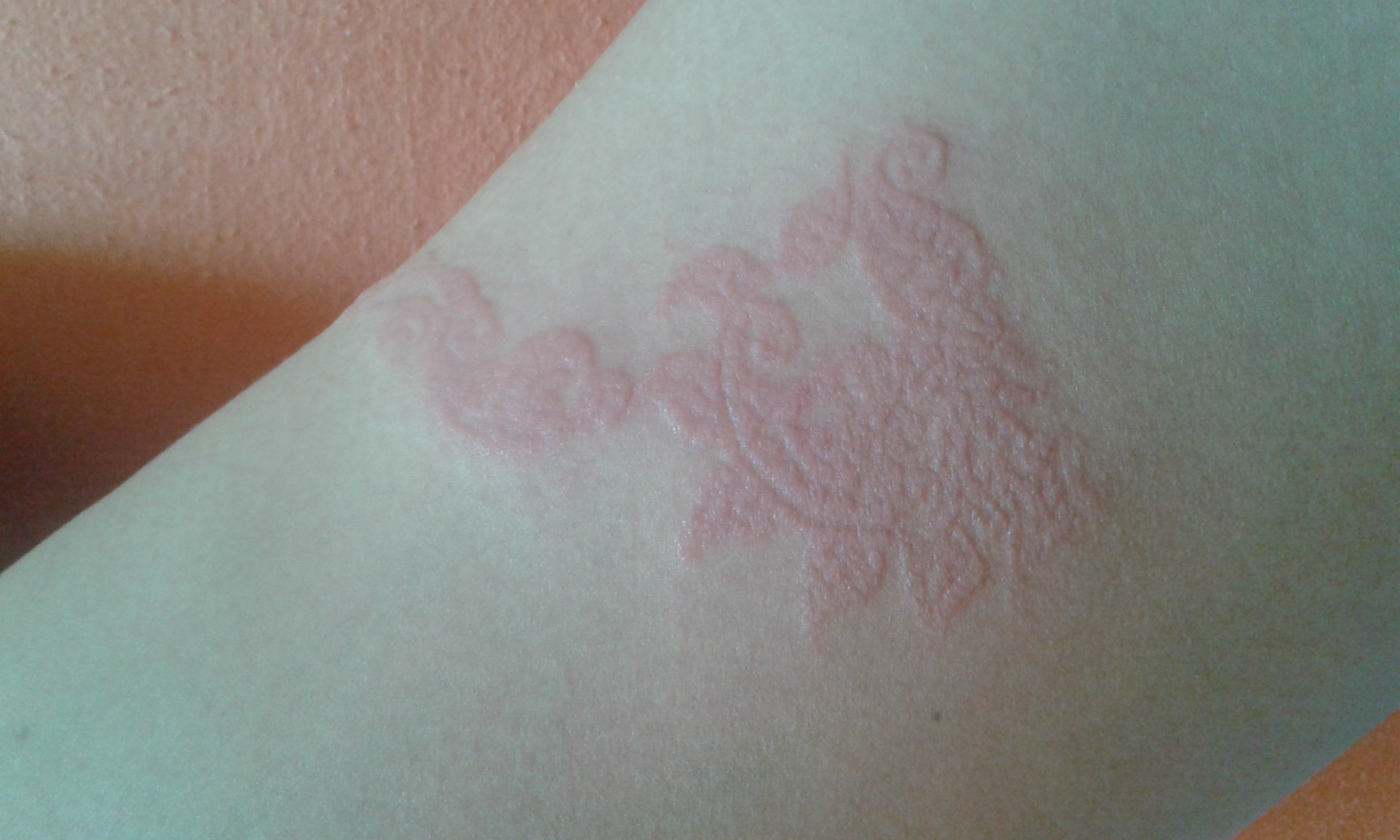 Hallo Hab Mir Ein Henna Tattoo Machen Lassen Ich Bin Total Ellergisch Jucken Ausschlag Pickel Schwellung Bleiben Narben Was Dagegen Tun Habsalbe Allergie Henna Tattoo