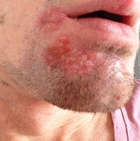 Hallo Habe Da Einen Ausschlag Am Kinn Kann Es Sein Das Ich Auf Die Katze Reagiere Prick Test Schlagt Positiv An Tranende Augen Und Schnupfen Habe Ich Nicht Hallo Habe Da Einen Ausschlag Am Kinn Kann Es Sein Das Ich Auf Die Katze Reagiere Prick Test Schlagt Positiv An Tranende Augen Und Schnupfen Habe Ich Nicht