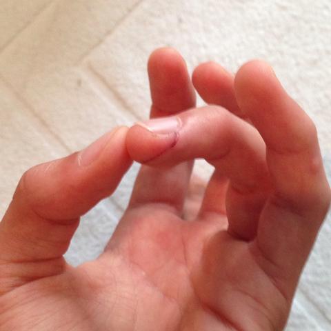 Hallo Habe Mir Am Mittwoch In Den Finger Geschnitten Schnitt Taubheitsgefuehl Hallo Habe Mir Am Mittwoch In Den Finger Geschnitten Schnitt Taubheitsgefuehl
