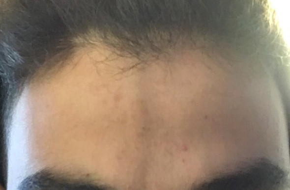 Ader Geplatzt Fuss Geplatzte Aderchen An Den Beinen Heilmittel Ursachen Vermeiden Was Tun Ader Geplatzt Fuss Geplatzte Aderchen An Den Beinen Heilmittel Ursachen Vermeiden Was Tun