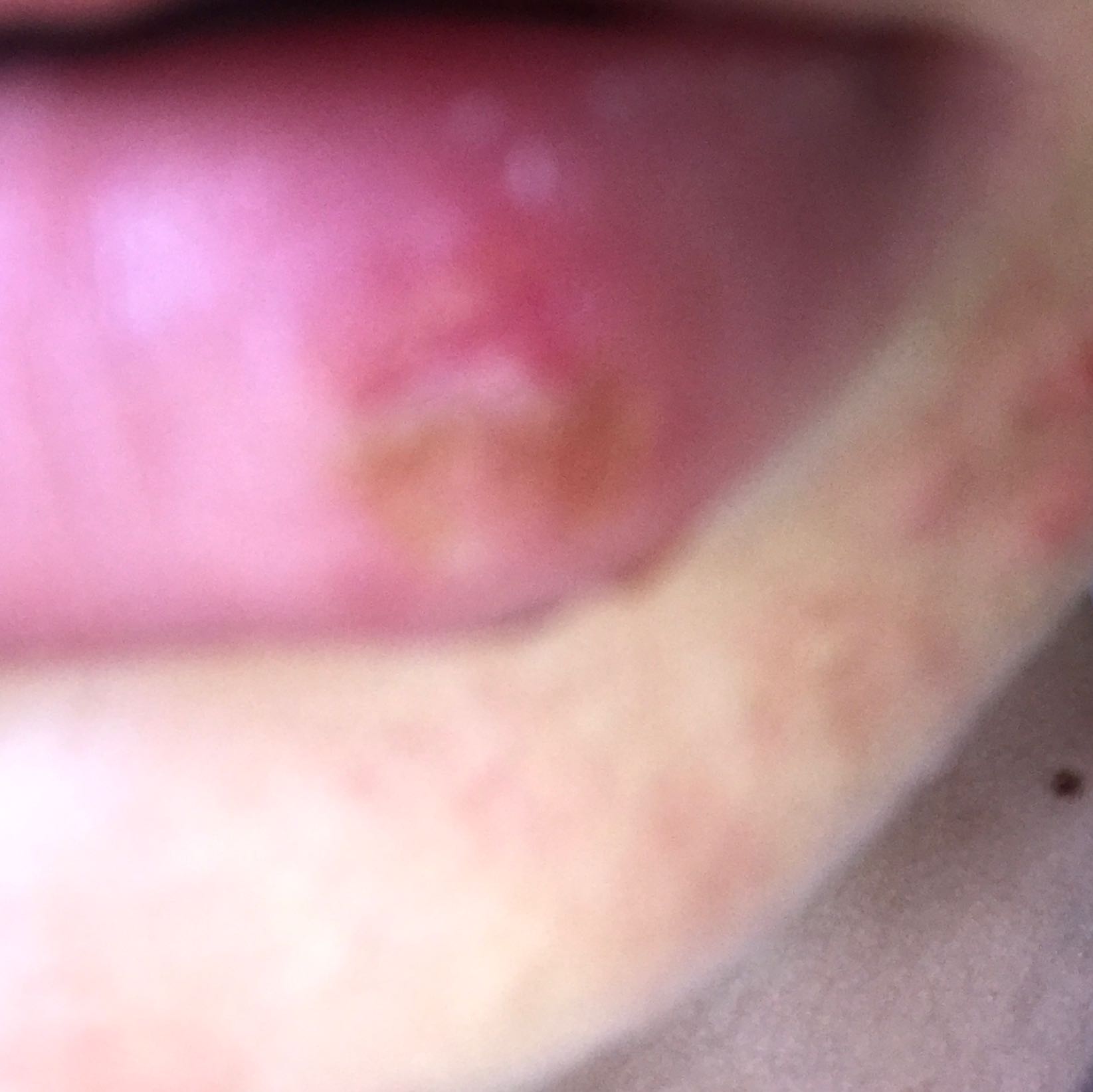 Hallo Ich Brauche Hilfe Zum Thema Lippen Herpes Gesundheit Und Medizin Medizin Lippe