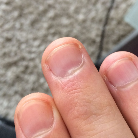 Blauer Rand vor dem nagelbett normal ? - (Nägel, Finger)