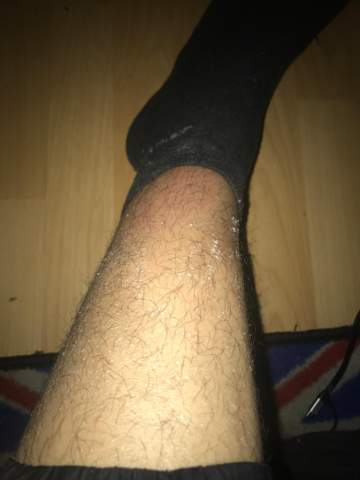 Hallo Ich Habe Einen Juckreiz Am Bein Und Jetzt Sieht Mein Bein So Aus Ist Das Normal Und Was Hilft Dagegen Beine Hautpflege Trockene Haut