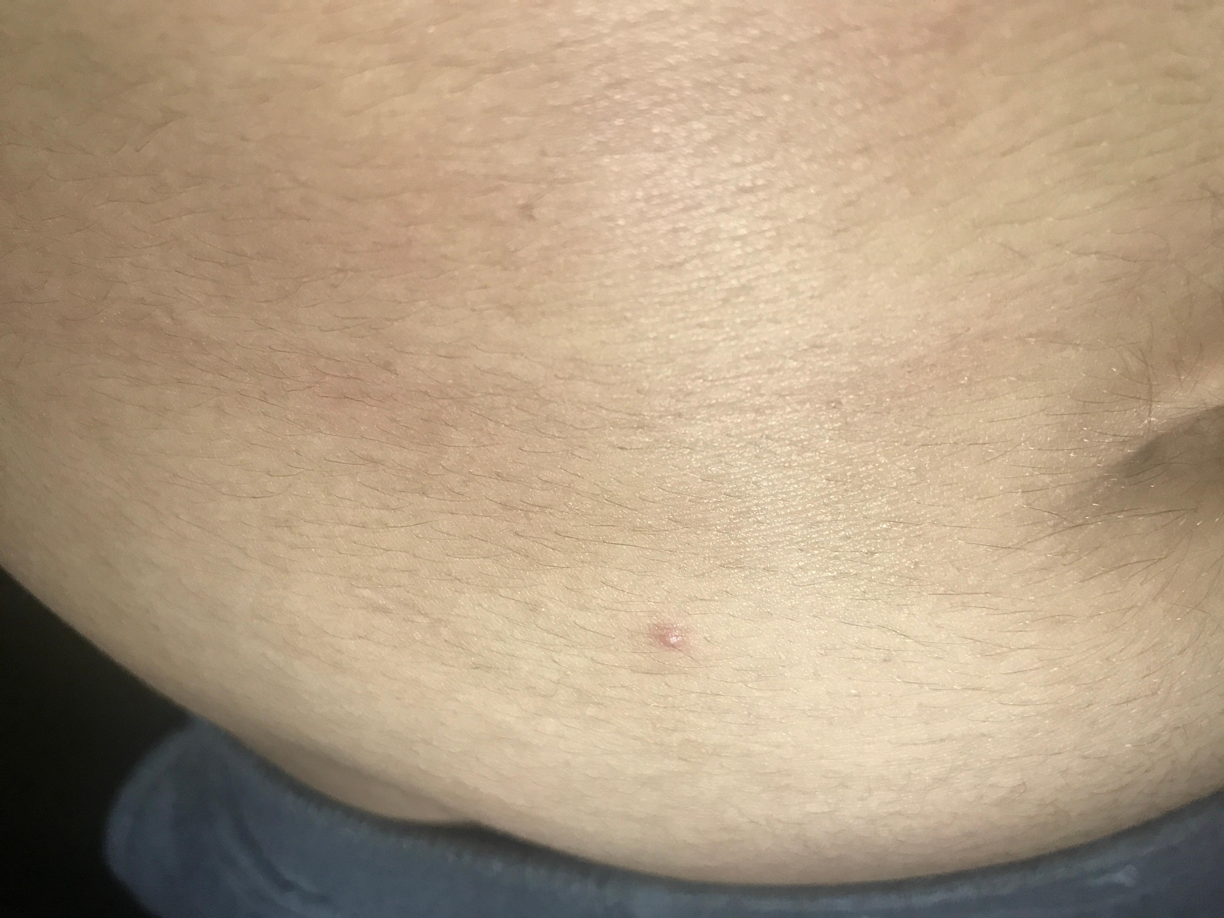 Hallo Ich Habe Einen Pickel Am Bauch Der Juckt Soll Ich Zum Hautarzt Oder Sieht Es Harmlos Aus Juckreiz Hallo Ich Habe Einen Pickel Am Bauch Der Juckt Soll Ich Zum Hautarzt Oder Sieht Es Harmlos Aus Juckreiz