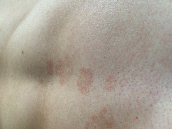 Hallo Ich Habe Seid Einigen Tagen Rote Flecken Ca 1 6 Cm Durchmesser Auf Meinem Bauch Was Kann Die Ursache Dafur Sein Neurodermitis Pilzinfektion Hallo Ich Habe Seid Einigen Tagen Rote Flecken Ca 1 6 Cm Durchmesser Auf Meinem Bauch Was Kann Die Ursache Dafur Sein Neurodermitis Pilzinfektion
