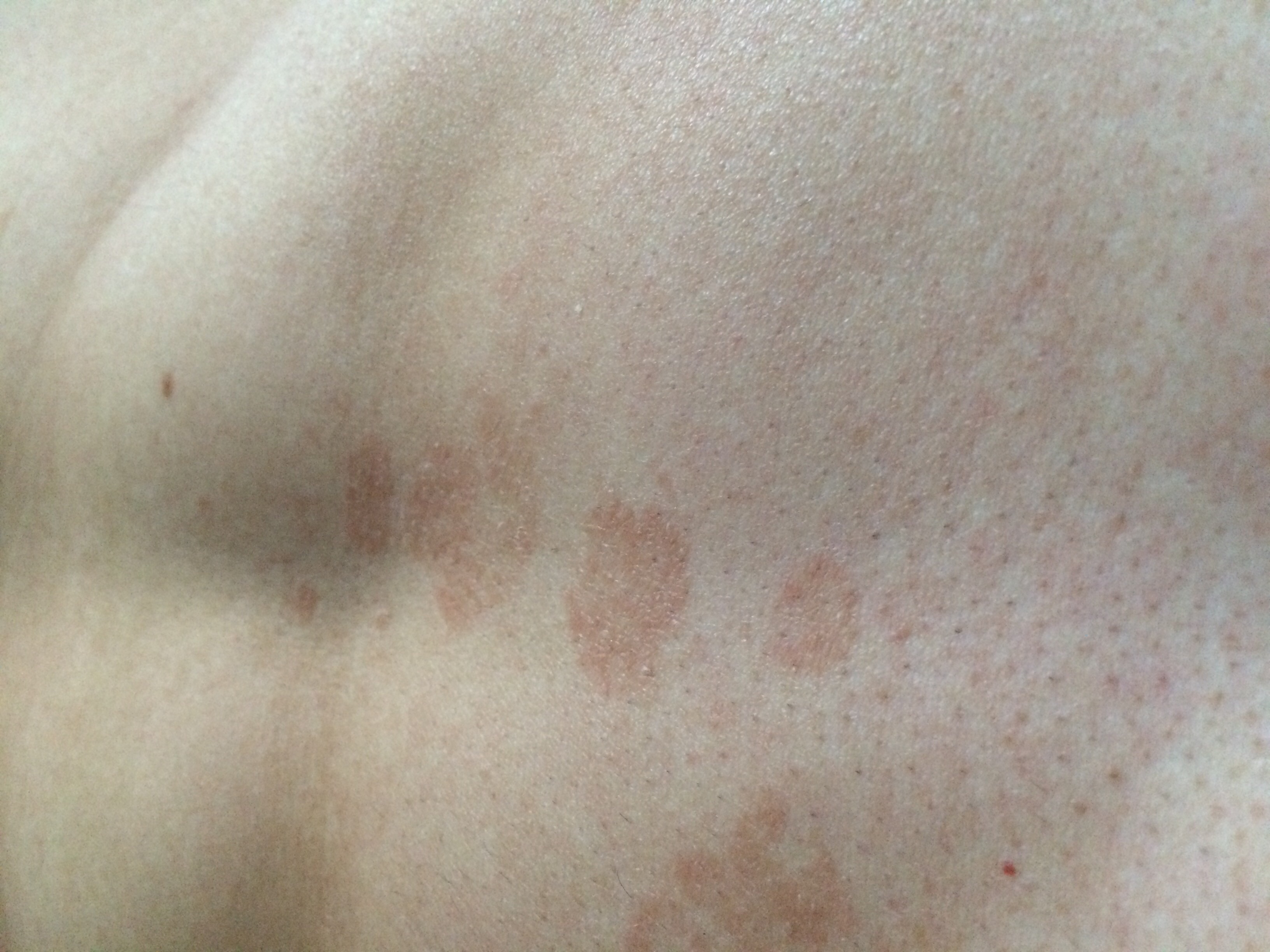 Hallo ich habe seid einigen Tagen Rote Flecken ca 1,6 cm Durchmesser Hallo ich habe seid einigen Tagen Rote Flecken ca 1,6 cm Durchmesser