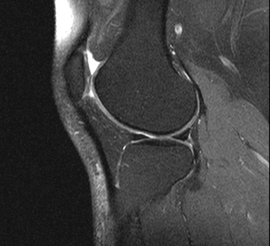 Hallo Ich Komme Gerade Vom Mrt Und Habe Eine Cd Mitbekommen V A Osteochondrosis Dissecans Erkennt Jemand Diese Diagnose Oder Ggf Arthrose Knie Hallo Ich Komme Gerade Vom Mrt Und Habe Eine Cd Mitbekommen V A Osteochondrosis Dissecans Erkennt Jemand Diese Diagnose Oder Ggf Arthrose Knie