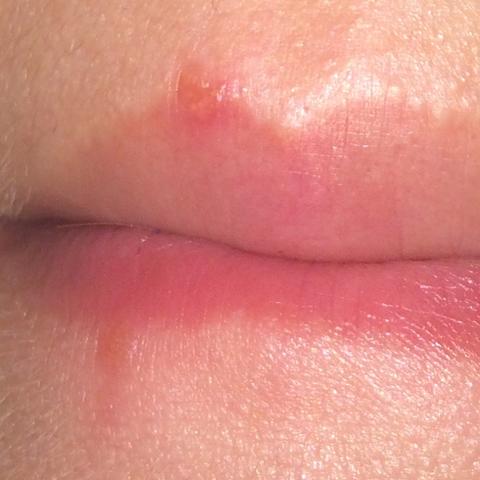 Hallo Ist Das Herpes Lippe