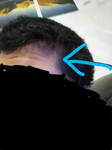 Hallo Ist Es Normal Dass Man In Der Pupertat Schuppen Und Die Haare Langsamer Wachsen Unten Mehr Gesundheit Und Medizin Gesundheit Medizin Hallo Ist Es Normal Dass Man In Der Pupertat Schuppen Und Die Haare Langsamer Wachsen Unten Mehr Gesundheit Und Medizin Gesundheit Medizin