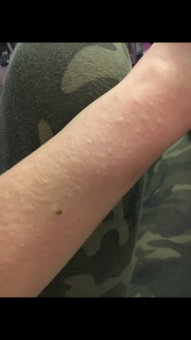 Hallo Kann Mir Bei Diesem Ausschlag Jemand Weiterhelfen S Foto Es Juckt Und Sobald Man Kratzt Werden Die Weisen Blaschen Immer Mehr Gesundheit Und Medizin Haut Juckreiz Hallo Kann Mir Bei Diesem Ausschlag Jemand Weiterhelfen S Foto Es Juckt Und Sobald Man Kratzt Werden Die Weisen Blaschen Immer Mehr Gesundheit Und Medizin Haut Juckreiz