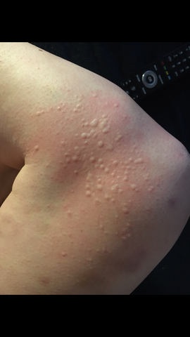 Hallo Kann Mir Bei Diesem Qualenden Quaddeln Jemand Weiterhelfen Es Juckt Und Sie Traten Vereinzelt An Stellen Am Korper Auf Gesundheit Und Medizin Allergie Juckreiz Hallo Kann Mir Bei Diesem Qualenden Quaddeln Jemand Weiterhelfen Es Juckt Und Sie Traten Vereinzelt An Stellen Am Korper Auf Gesundheit Und Medizin Allergie Juckreiz