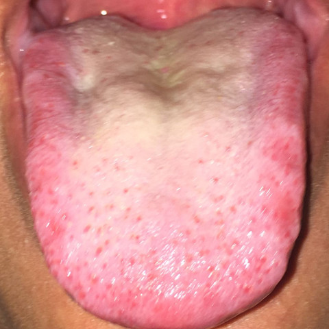 Gelbliche Zunge, trotz säubern, jeden Tag das selbe trotz putzen - (Zunge, Infektion)