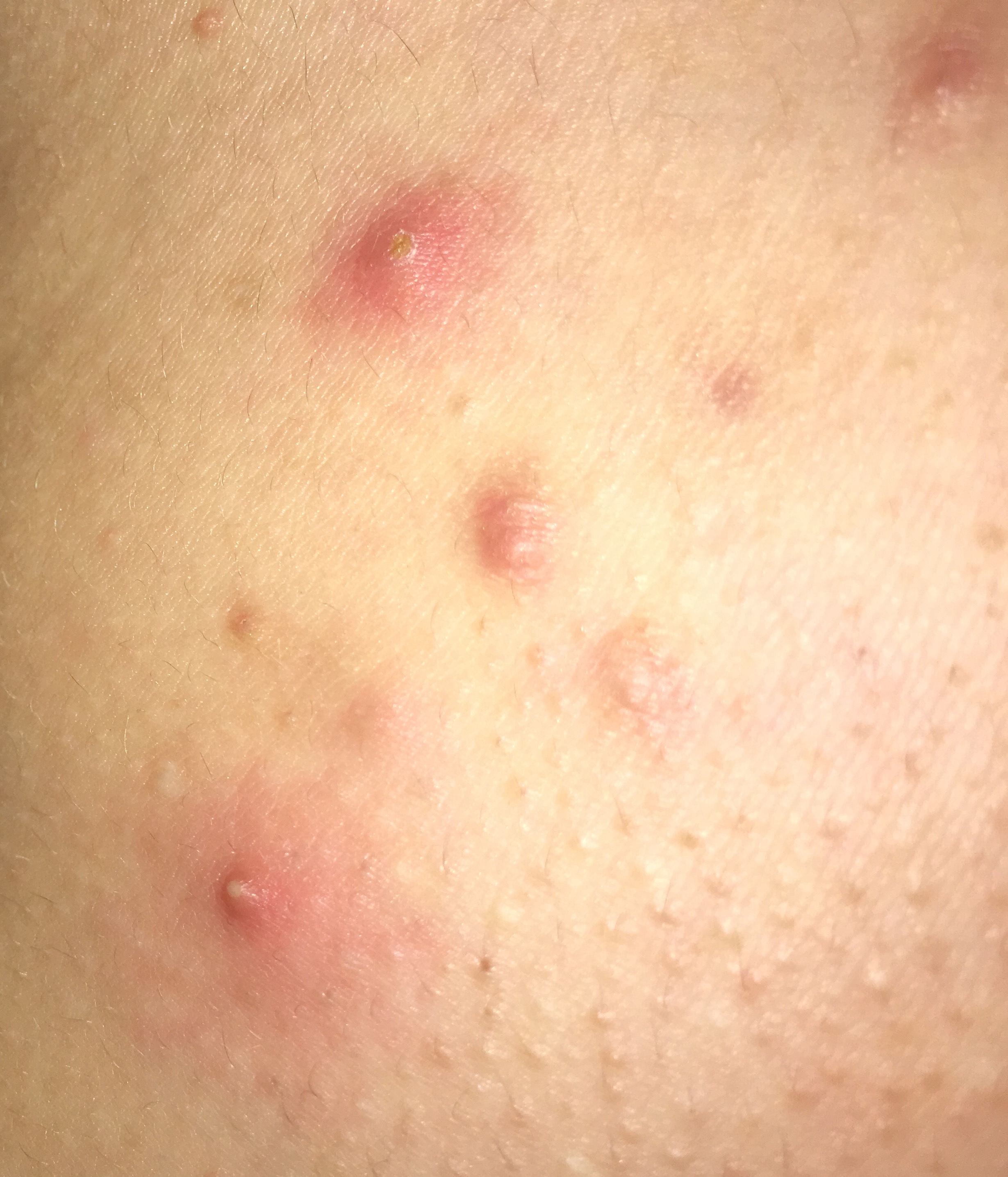 Hallo Kennt Ihr Hausmittel Gegen Pickel Auf Dem Dekollete Dekoltee