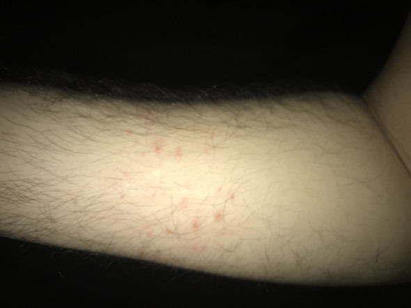 Hallo Leute Ein Freund Hatte Anfangs Februar Ungeschutzten Sex Und Bekam An Seinm Arm Einen Ausschlag Bild Deutet Das Evtl Auf Hiv Krankheit Aids Hallo Leute Ein Freund Hatte Anfangs Februar Ungeschutzten Sex Und Bekam An Seinm Arm Einen Ausschlag Bild Deutet Das Evtl Auf Hiv Krankheit Aids
