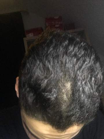 Hallo Leute Meine Haare Wachsen Einfach Da Vorne Nicht Und Ich Finde Es Sieht Sehr Komisch Aus Was Konnte Ich Machen Junge Frisur