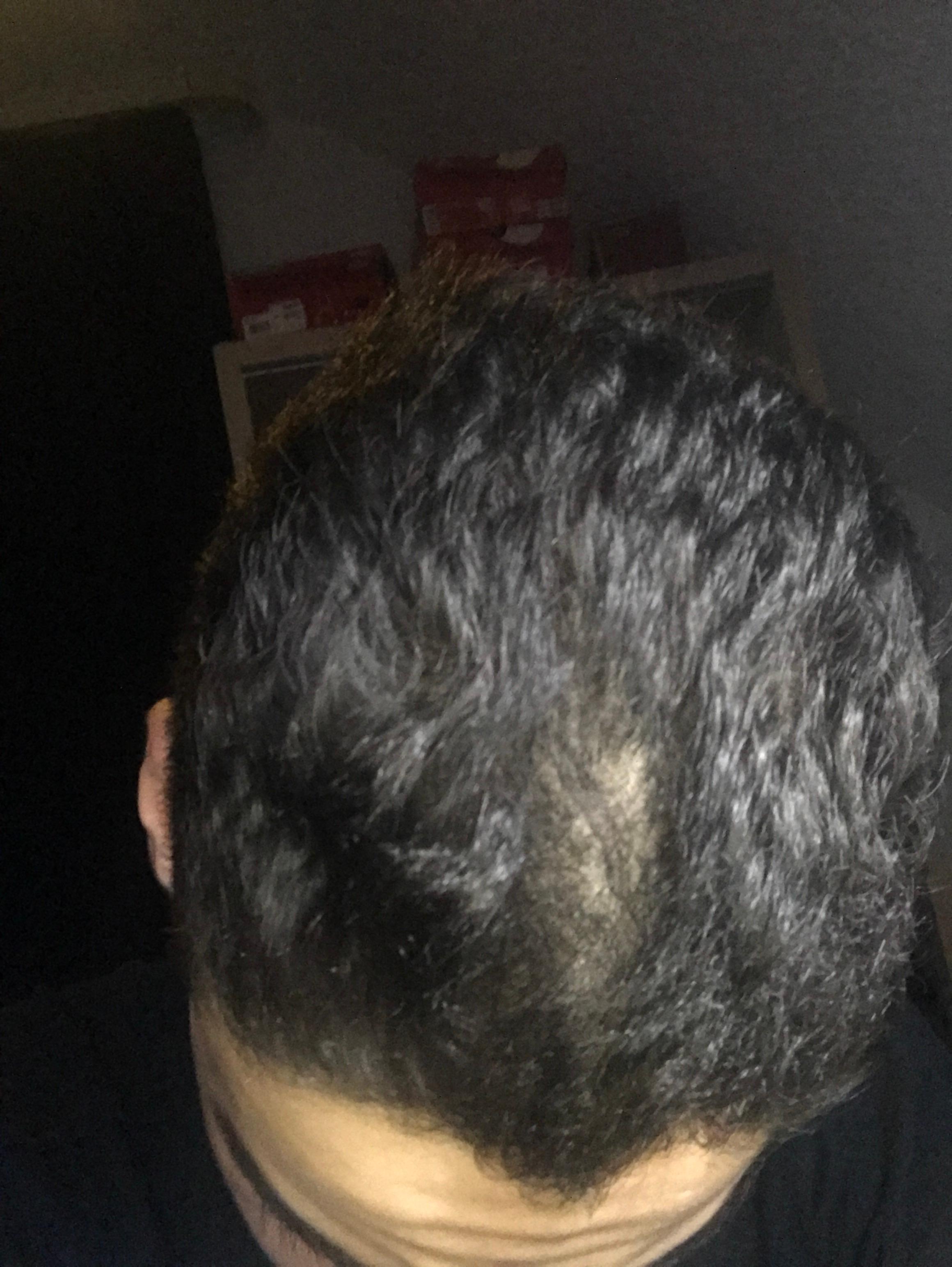 meine haare wachsen einfach da vorne