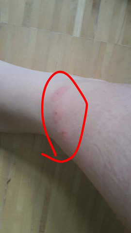 Hallo Leute Was Hilft Gegen Diese Muckenstiche Ausser Kuhlgehl Mucken Stich Schlimm Hallo Leute Was Hilft Gegen Diese Muckenstiche Ausser Kuhlgehl Mucken Stich Schlimm