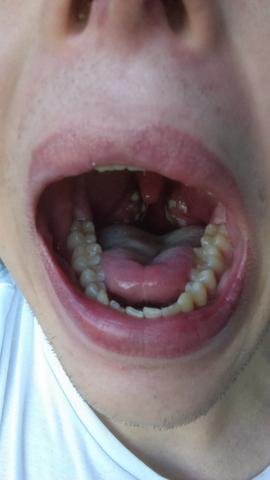 Hallo Liebe Community Ich Habe Seit 4 Tagen Starke Halsschmerzen Und Schluckbeschwerden Sollt Ich Lieber Zum Arzt Gehen Und Antibiotikum Holen Danke Gesundheit Mandelentzundung Angina Hallo Liebe Community Ich Habe Seit 4 Tagen Starke Halsschmerzen Und Schluckbeschwerden Sollt Ich Lieber Zum Arzt Gehen Und Antibiotikum Holen Danke Gesundheit Mandelentzundung Angina