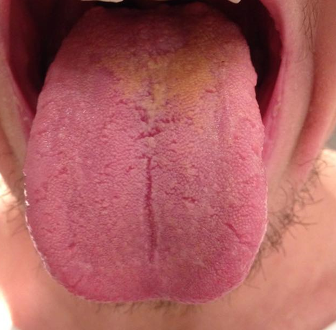 Hallo Liebe Community Ich Wollte Mal Fragen Ob So Eine Normale Zunge Aussieht Diese Gelbliche Verfarbung Macht Mir Sorgen Ist Das Normal Gelb Belag Hallo Liebe Community Ich Wollte Mal Fragen Ob So Eine Normale Zunge Aussieht Diese Gelbliche Verfarbung Macht Mir Sorgen Ist Das Normal Gelb Belag