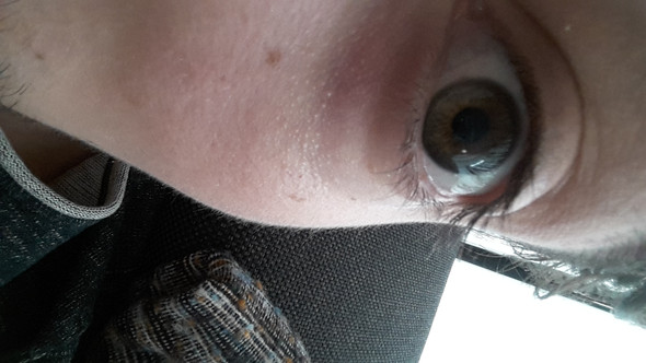 Hallo Miteinander Komische Schwellung Unter Dem Auge Woher Kommt Das Und Wie Bringt Man Es Weg P Ich Bin Erst 20 Augen Hallo Miteinander Komische Schwellung Unter Dem Auge Woher Kommt Das Und Wie Bringt Man Es Weg P Ich Bin Erst 20 Augen
