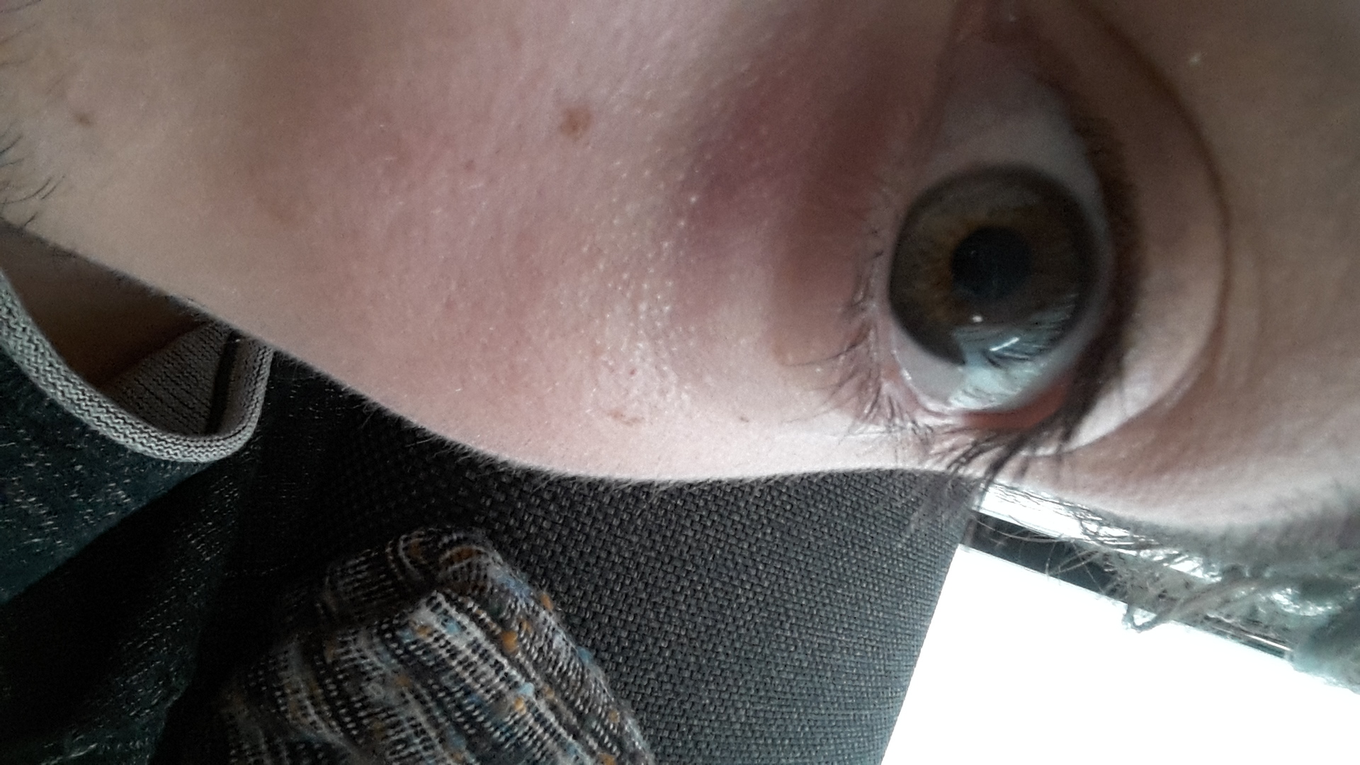 Hallo Miteinander Komische Schwellung Unter Dem Auge Woher Kommt Das Und Wie Bringt Man Es Weg P Ich Bin Erst 20 Augen Hallo Miteinander Komische Schwellung Unter Dem Auge Woher Kommt Das Und Wie Bringt Man Es Weg P Ich Bin Erst 20 Augen