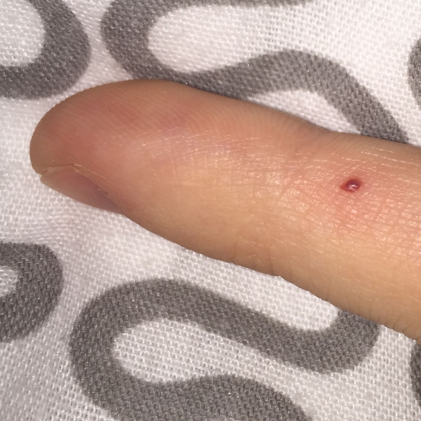 Hallo roter lila pickel auf dem finger (Gesundheit, Medizin, Haut) pickel an hand