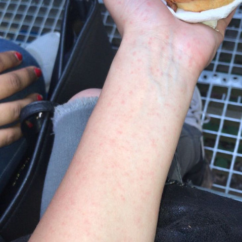 Hornzipfel Eichel Kleine Weisse Pickel An Der Eichel 2020 04 20