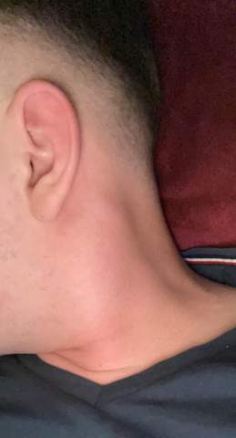 Geschwollen rechts am hals lymphknoten Geschwollene Lymphknoten