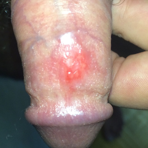 Bild Entzündung  - (Penis, Vorhaut, Urologie)