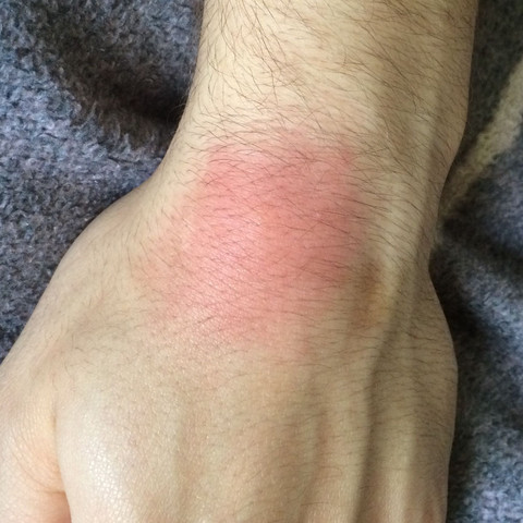 Handgelenk - (Gesundheit, Rötung, Mückenstich)