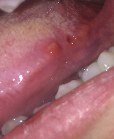 Get Pickel Auf Der Zunge Hinten Gif