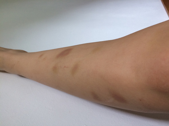 Hallo Ich Habe Seit Einiger Zeit Ziemlich Viele Blaue Flecken Aber Weiss Nicht Woher Ich Gehe Morgen Zum Arzt Habt Ihr Eine Vermutung Woher Das Kommen Kann Gesundheit Und Medizin Gesundheit Medizin Hallo Ich Habe Seit Einiger Zeit Ziemlich Viele Blaue Flecken Aber Weiss Nicht Woher Ich Gehe Morgen Zum Arzt Habt Ihr Eine Vermutung Woher Das Kommen Kann Gesundheit Und Medizin Gesundheit Medizin